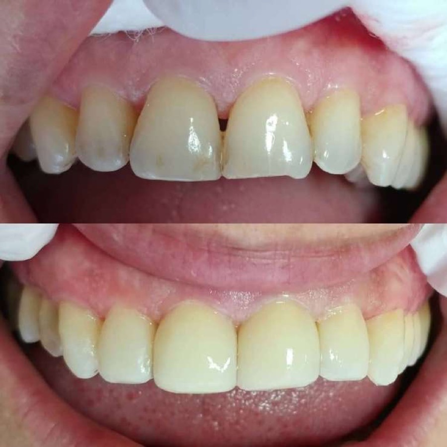 Bliss Dental — a real single-visit case